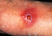 Infected wound from thorn on knee of man