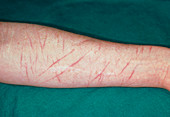 Self-inflicted wounds on arm