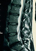 MRI scan of the back showing prolapsed disc