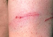 Close-up of scratched and bruised arm on day 1