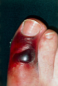 Bruising caused by a fracture of the big toe