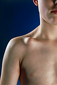 Deformed collarbone caused by sports injury