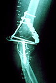 X-ray of a pinned elbow joint fracture