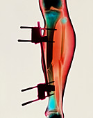 Coloured X-ray of a fractured tibia & fibula