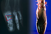 Stapled toe fracture