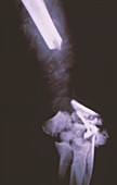 Broken arm X-ray