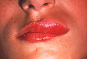 Swollen lip