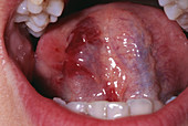 Tongue haematoma