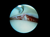 Torn knee meniscus