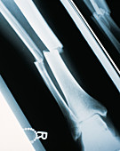 Lower leg fracture,X-ray
