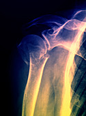 Broken upper arm bone,X-ray