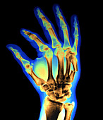 Broken hand bone,X-ray