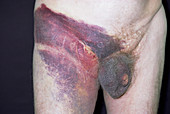 Bruised groin