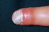 Crushed fingertip