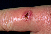 Infected cut
