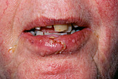 Infected lacerated lip