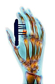 Pinned finger fracture,X-ray