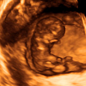 Umbilical hernia,3-D ultrasound scan