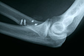 Repaired muscle injury,X-ray