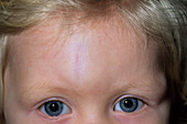 Bump on a child's head