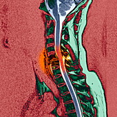 Broken neck,MRI