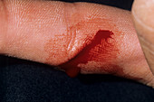 Finger laceration