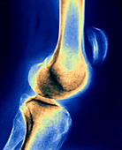 Dislocated kneecap,X-ray