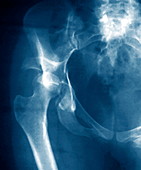 Hip injury,X-ray