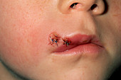 Lacerated lip