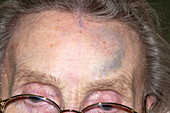 Bruised forehead