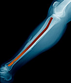 Pinned broken leg,X-ray