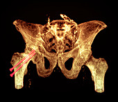 Pinned broken hip,X-ray