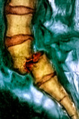 Spondylolisthesis back deformity,MRI