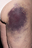 Bruise in warfarin patient