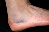 Fractured ankle bone
