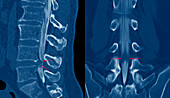 Slipped disc,CT scans