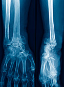 Fractured wrist,X-rays
