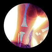 Corrected knee dislocation,X-ray