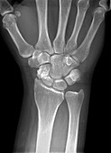 Fractured wrist,X-ray