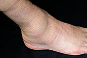 Sprained ankle