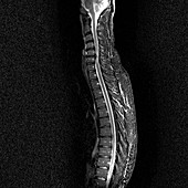 Slipped disc,MRI scan