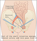 Inguinal hernia,artwork