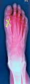 Pinned foot,X-ray