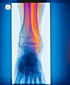 Deformed ankle after fracture