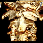 Fractured atlas vertebra,3D CT scan