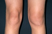 Normal and swollen knees
