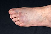 Bruised foot following crush injury