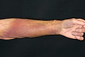 Bruised warfarin patient's arm