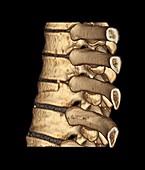 Fractured spine,3D CT scan