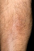 Superficial phlebitis after leg injury